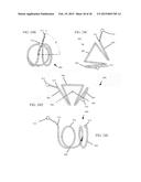 Torque Alleviating Intra-Airway Lung Volume Reduction Compressive Implant     Structures diagram and image