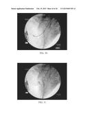 Torque Alleviating Intra-Airway Lung Volume Reduction Compressive Implant     Structures diagram and image