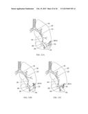 Torque Alleviating Intra-Airway Lung Volume Reduction Compressive Implant     Structures diagram and image