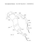 Torque Alleviating Intra-Airway Lung Volume Reduction Compressive Implant     Structures diagram and image