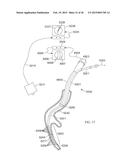 Torque Alleviating Intra-Airway Lung Volume Reduction Compressive Implant     Structures diagram and image