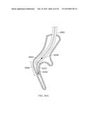 Torque Alleviating Intra-Airway Lung Volume Reduction Compressive Implant     Structures diagram and image