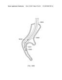 Torque Alleviating Intra-Airway Lung Volume Reduction Compressive Implant     Structures diagram and image