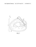 PROTECTIVE SLEEVE FOR A MEDICAL DEVICE diagram and image