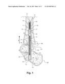 Intramedullary Nail, System, and Method With Dynamic Compression diagram and image