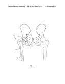 Osteotome Guide Configured to Attach to an Implanted Femoral Component diagram and image