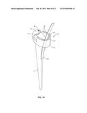 Osteotome Guide Configured to Attach to an Implanted Femoral Component diagram and image