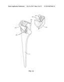 Osteotome Guide Configured to Attach to an Implanted Femoral Component diagram and image