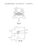 SYSTEMS AND METHODS FOR PROVIDING ELECTRICAL STIMULATION OF MULTIPLE     DORSAL ROOT GANGLIA WITH A SINGLE LEAD diagram and image