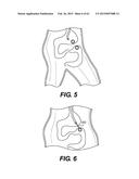 SELF-ASSEMBLING MAGNETIC ANASTOMOSIS DEVICE HAVING AN EXOSKELETON diagram and image