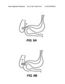 SELF-ASSEMBLING MAGNETIC ANASTOMOSIS DEVICE HAVING AN EXOSKELETON diagram and image