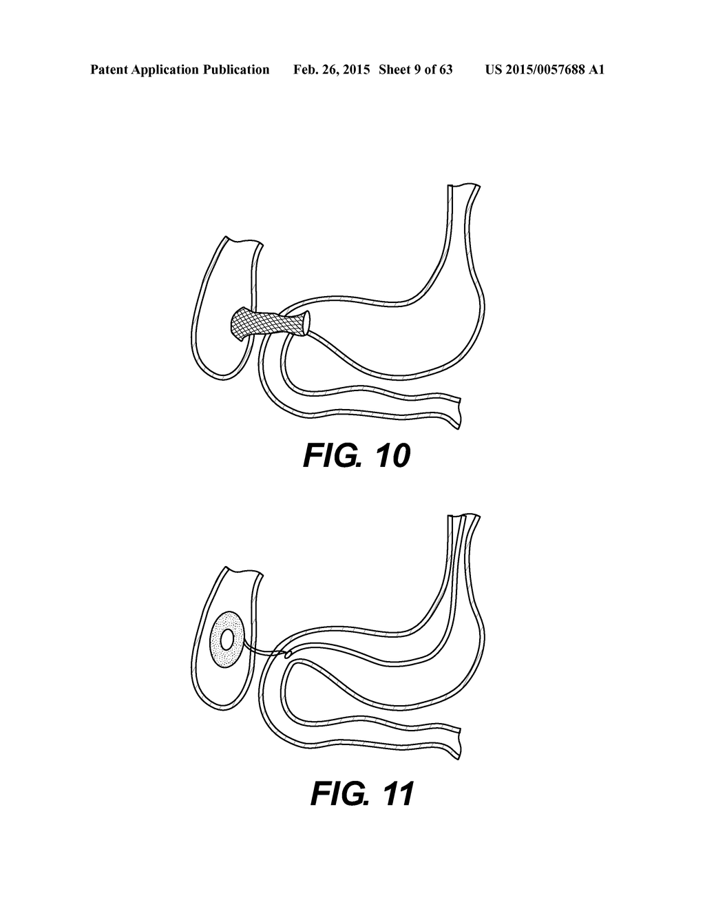 SELF-ASSEMBLING MAGNETIC ANASTOMOSIS DEVICE HAVING AN EXOSKELETON - diagram, schematic, and image 10