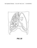 SELF-ASSEMBLING MAGNETIC ANASTOMOSIS DEVICE HAVING AN EXOSKELETON diagram and image