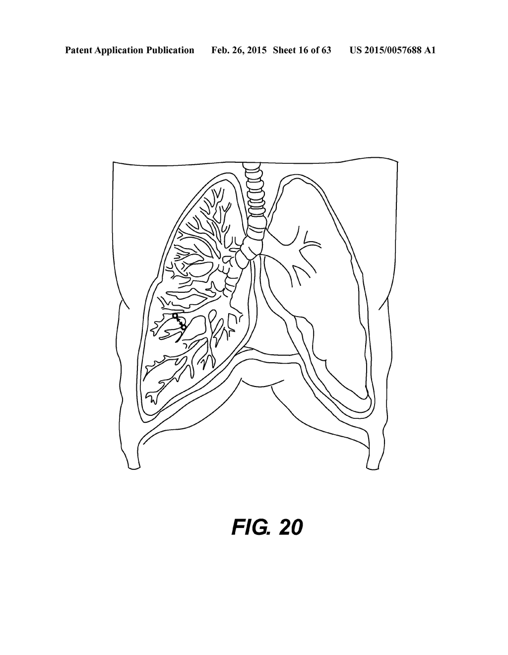 SELF-ASSEMBLING MAGNETIC ANASTOMOSIS DEVICE HAVING AN EXOSKELETON - diagram, schematic, and image 17