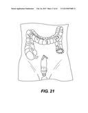 SELF-ASSEMBLING MAGNETIC ANASTOMOSIS DEVICE HAVING AN EXOSKELETON diagram and image