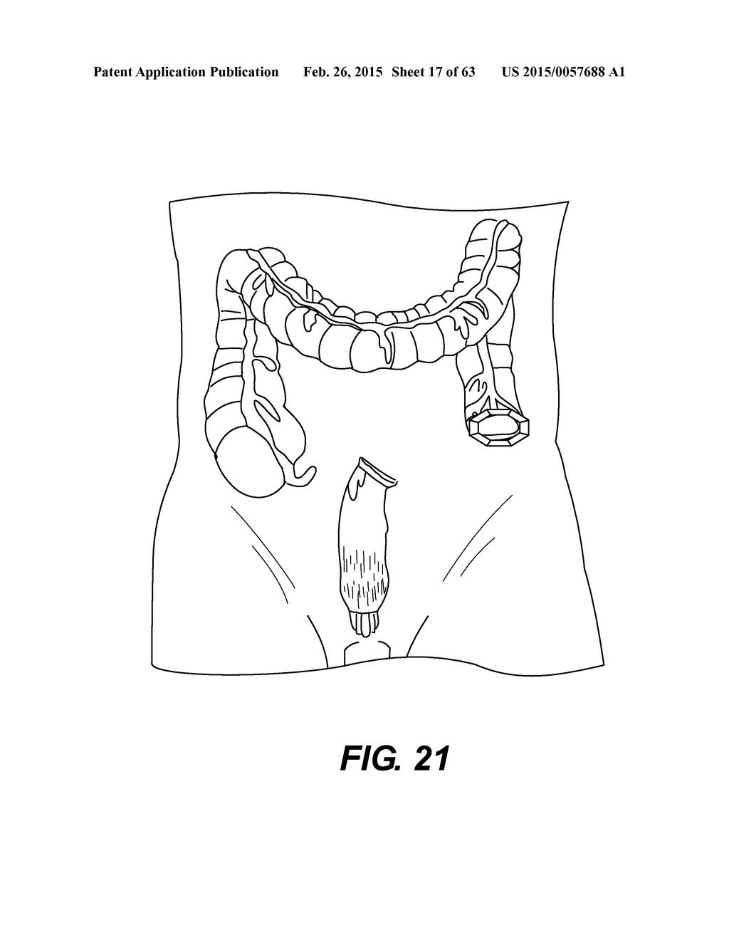 SELF-ASSEMBLING MAGNETIC ANASTOMOSIS DEVICE HAVING AN EXOSKELETON - diagram, schematic, and image 18