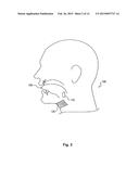 IMPLANT ENCAPSULATION diagram and image