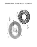 IMPLANT ENCAPSULATION diagram and image