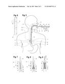 STENT DELIVERY DEVICE diagram and image