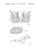 METHOD FOR TREATING FECAL INCONTINENCE diagram and image