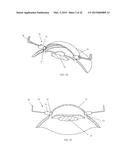 IRIS RETRACTOR diagram and image