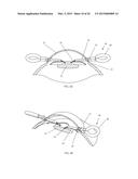 IRIS RETRACTOR diagram and image