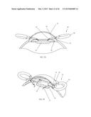 IRIS RETRACTOR diagram and image