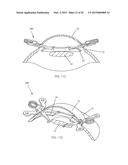 IRIS RETRACTOR diagram and image