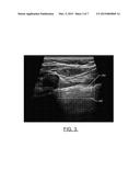 Automated Pneumothorax Detection diagram and image