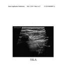 Automated Pneumothorax Detection diagram and image