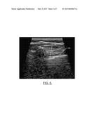 Automated Pneumothorax Detection diagram and image