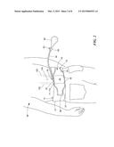 INFLATABLE COMPRESSION WRAP FOR DIRECT SUPPORT OF THE SPINOUS PROCESS IN     THE LUMBAR SPECIFIC SPINE REGION diagram and image