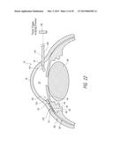 SYSTEMS AND METHODS FOR DELIVERING AN OCULAR IMPLANT TO THE SUPRACHOROIDAL     SPACE WITHIN AN EYE diagram and image