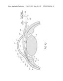 SYSTEMS AND METHODS FOR DELIVERING AN OCULAR IMPLANT TO THE SUPRACHOROIDAL     SPACE WITHIN AN EYE diagram and image