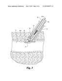 EXPANDABLE VASCULAR CLOSURE PLUG diagram and image