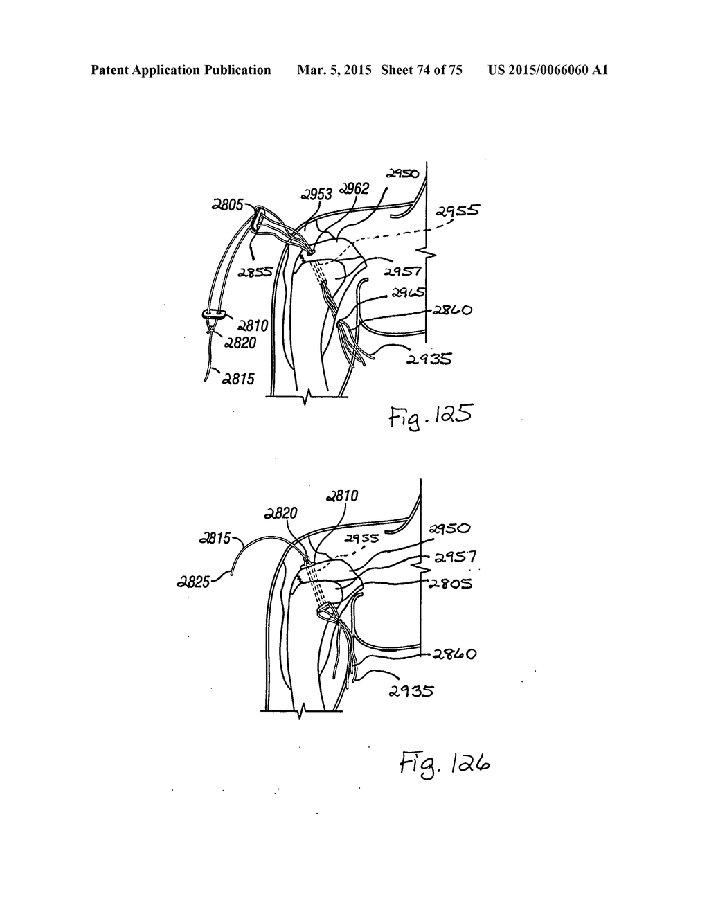 Methods for Tissue Repair - diagram, schematic, and image 75