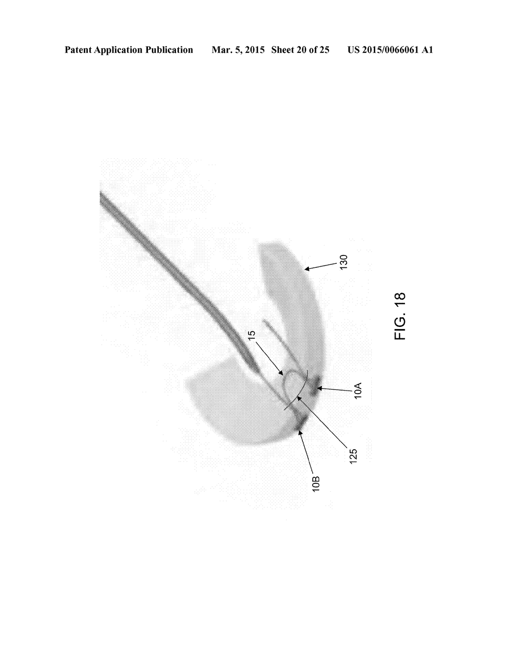 METHOD AND APPARATUS FOR MENISCAL REPAIR - diagram, schematic, and image 21