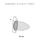 MEDICAL DEVICE FOR MODIFICATION OF LEFT ATRIAL APPENDAGE AND RELATED     SYSTEMS AND METHODS diagram and image