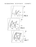 SUTURE TAPE WITH EXTERIOR SUTURE STRANDS diagram and image