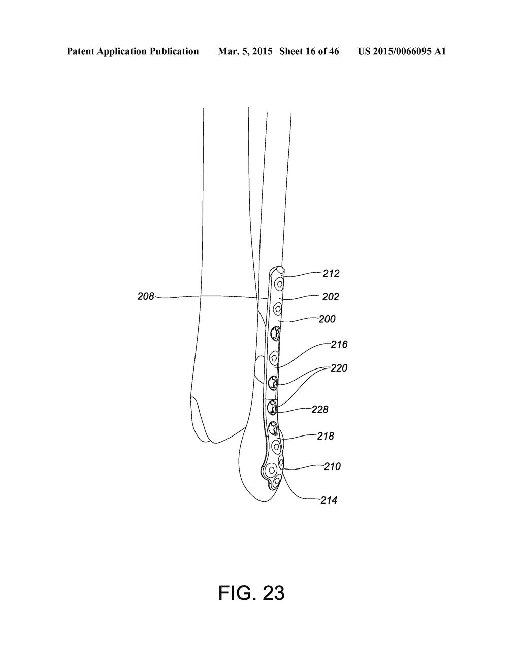 SYSTEMS AND METHODS FOR USING POLYAXIAL PLATES - diagram, schematic, and image 17