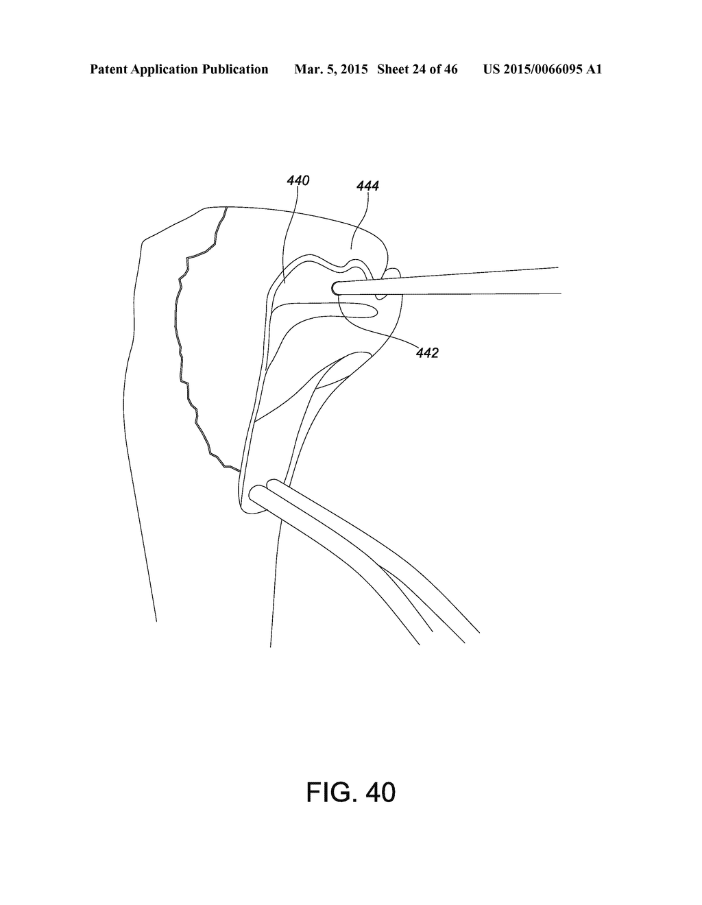 SYSTEMS AND METHODS FOR USING POLYAXIAL PLATES - diagram, schematic, and image 25