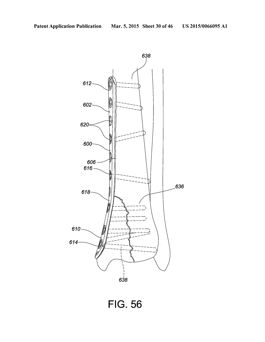 SYSTEMS AND METHODS FOR USING POLYAXIAL PLATES - diagram, schematic, and image 31