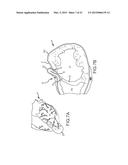 HEART ANCHOR POSITIONING DEVICES, METHODS, AND SYSTEMS FOR TREATMENT OF     CONGESTIVE HEART FAILURE AND OTHER CONDITIONS diagram and image