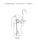 HEART ANCHOR POSITIONING DEVICES, METHODS, AND SYSTEMS FOR TREATMENT OF     CONGESTIVE HEART FAILURE AND OTHER CONDITIONS diagram and image