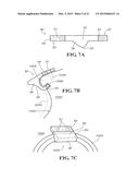 METHODS AND APPARATUS FOR FAI SURGERIES diagram and image