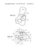 METHODS AND APPARATUS FOR FAI SURGERIES diagram and image