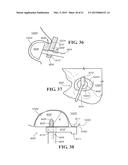 METHODS AND APPARATUS FOR FAI SURGERIES diagram and image