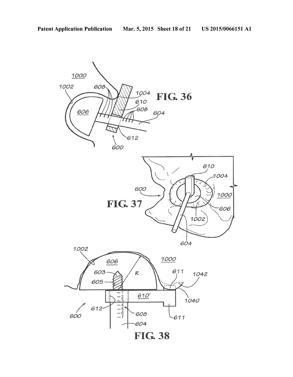 METHODS AND APPARATUS FOR FAI SURGERIES - diagram, schematic, and image 19