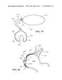 METHODS AND APPARATUS FOR FAI SURGERIES diagram and image