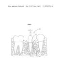 Dental Implant Cleaner diagram and image